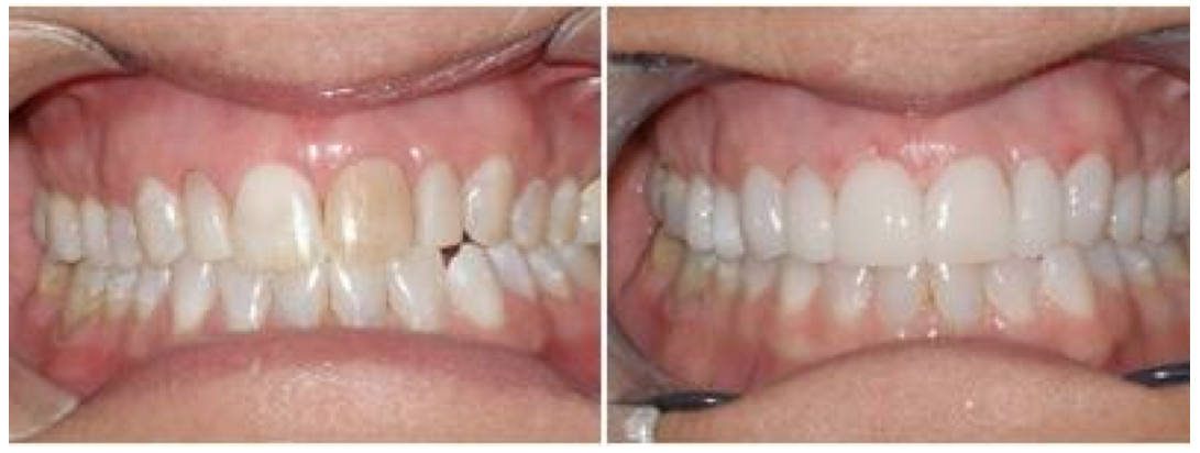 Fig. 3: Before and after the use of Lumineers