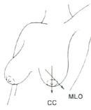 Figure 1: Two different views of the breast taken in mammographic screening: medio-lateral oblique (MLO) and cranio-caudal (CC)