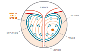 Figure 1. Schematic of the prostate gland, needle biopsy strategy and the
      tumour field effect.