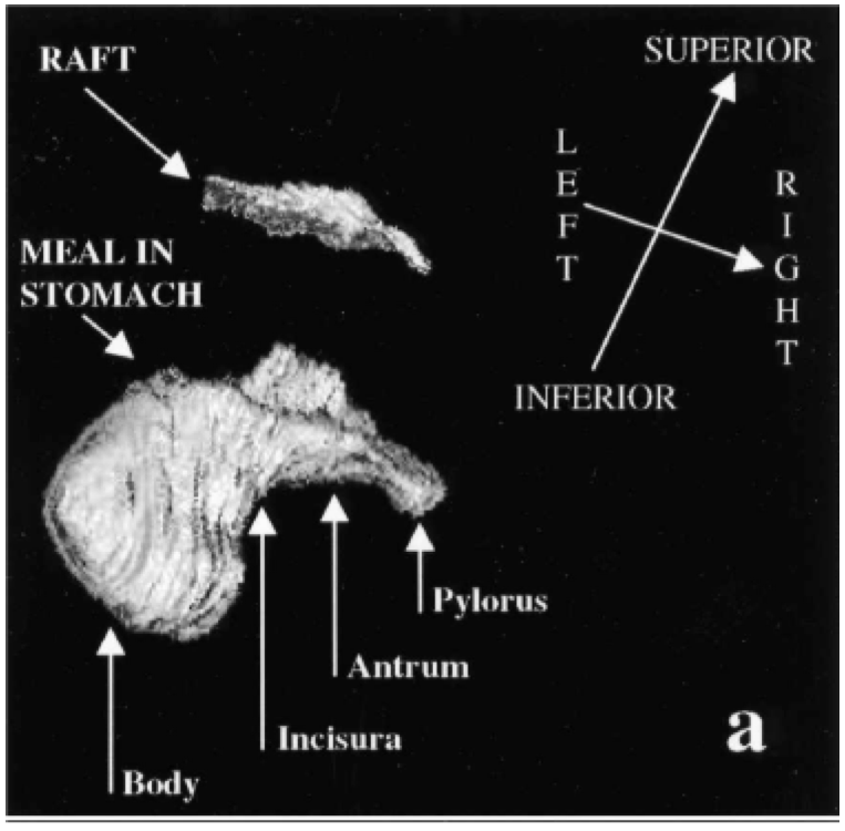 Figure 1: 3D MRI reconstruction
of a Gaviscon Advance raft and
underlying meal (NB: This figure is
from [6] and is also used in [A]).