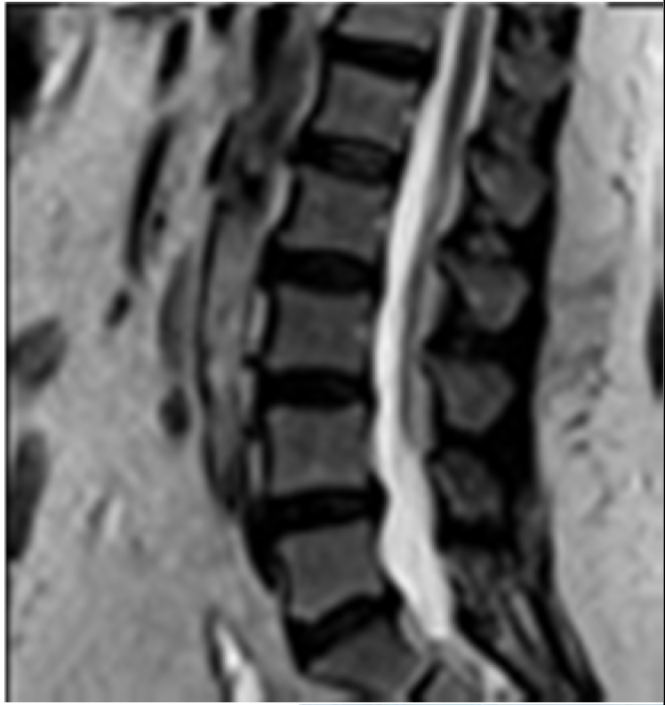 Top: Lumbar spine MRI scan (imaged under vertical compression)
