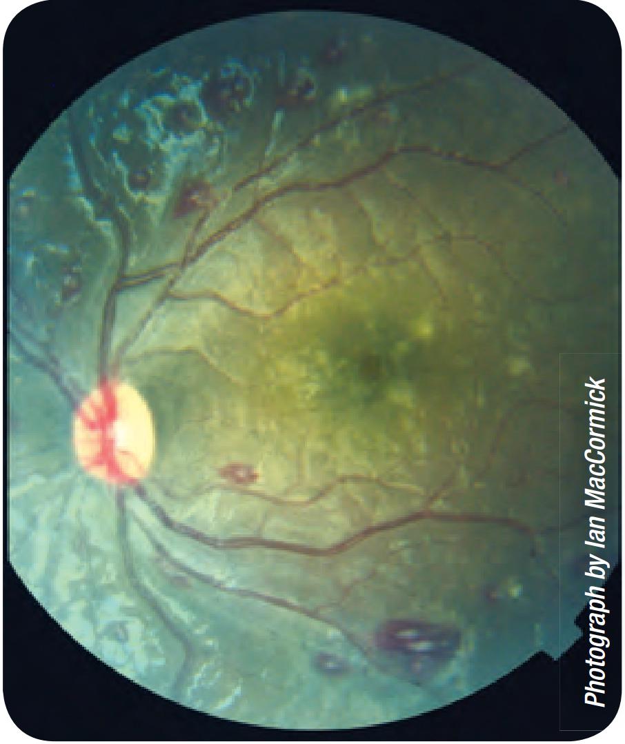 Note the characteristic patchy retinal whitening around the fovea (~3
      disc diameters to the right of the optic disc) and also some white-centred
      haemorrhages.